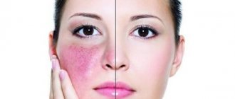 Rosacea in a woman
