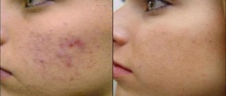 Salicylic-zinc acne paste: how to use