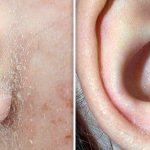 seborrheic dermatitis in the ears