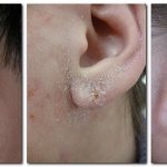 Peeling in the ears with otitis externa