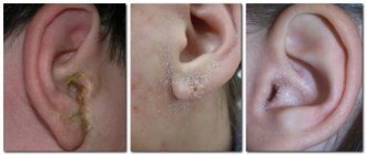 Peeling in the ears with otitis externa