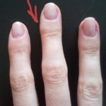 Bump on the finger from a pen: treatment of a callus