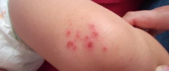 Symptoms of allergic dermatitis