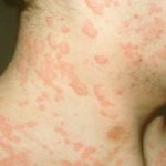 Symptoms and treatment of generalized urticaria
