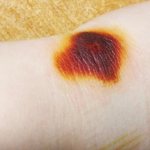 Symptoms of a burn from iodine and methods of its treatment