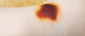 Symptoms of a burn from iodine and methods of its treatment