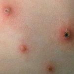 Chickenpox stages