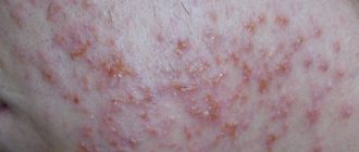 Staphylococcal pyoderma: photo