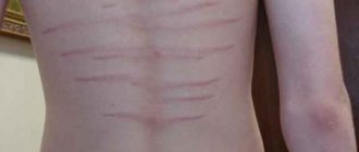 stretch marks in adolescents