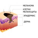 The structure of a birthmark
