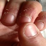 Сухая кутикула и кожа вокруг ногтей: методы лечения