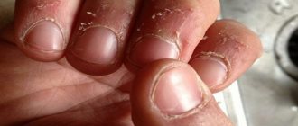 Dry cuticles and skin around nails: treatment methods