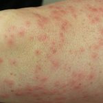 Rash on thighs may indicate insect bites