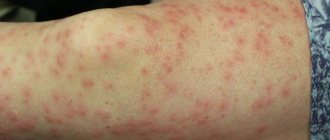 Rash on thighs may indicate insect bites