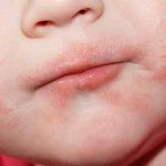Сыпь вокруг рта у взрослого и ребенка – причины, фото, лечение