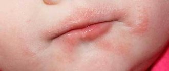 Сыпь вокруг рта у взрослого и ребенка – причины, фото, лечение