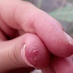The skin under the fingernails is cracking: causes, description of symptoms with photos and treatment