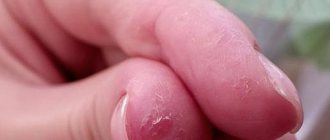 Трескается кожа под ногтями на руках: причины, описание симптомов с фото и лечение