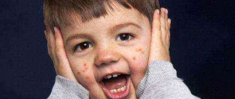 a child has pimples on the body without fever: causes and treatment