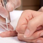 Wart removal