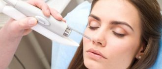 Removing pimples and blackheads with laser: reviews