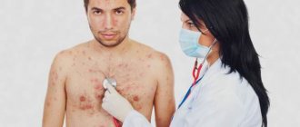 Chickenpox in adults