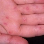 Blisters on the palms and soles: what are they?