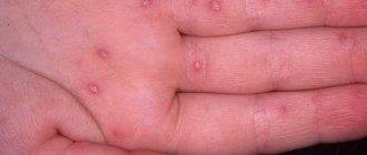 Blisters on the palms and soles: what are they?