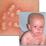 Let&#39;s find out which infections caused by herpes viruses occur in childhood...