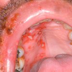 Выясняем, какими симптомами может проявлять себя поражение герпесом слизистых оболочек во рту...