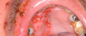 Выясняем, какими симптомами может проявлять себя поражение герпесом слизистых оболочек во рту...