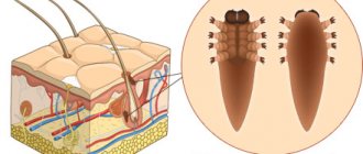 Ironwort acne illustration