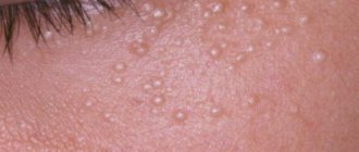 Oily acne on the skin of the face: how to get rid of it at home?